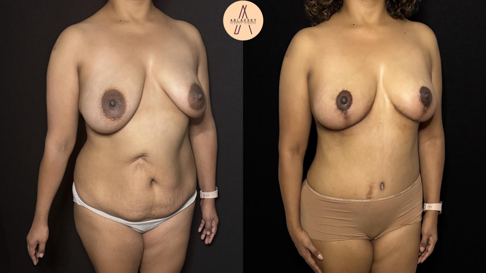 Before & After Mommy Makeover Case 404 Right Oblique View in San Antonio, Texas