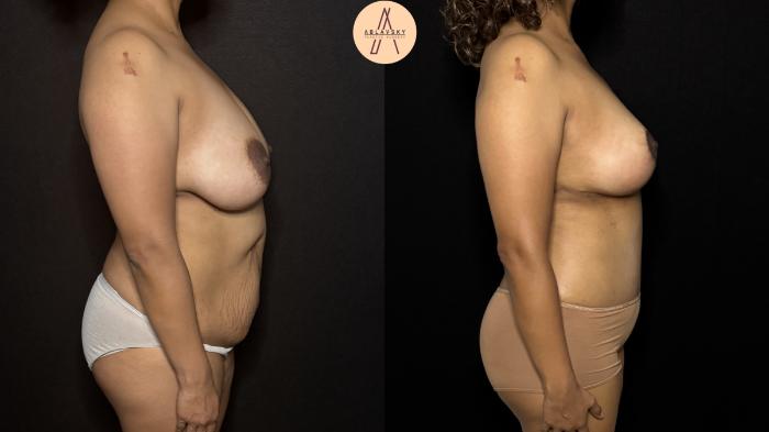 Before & After Mommy Makeover Case 404 Right Side View in San Antonio, Texas