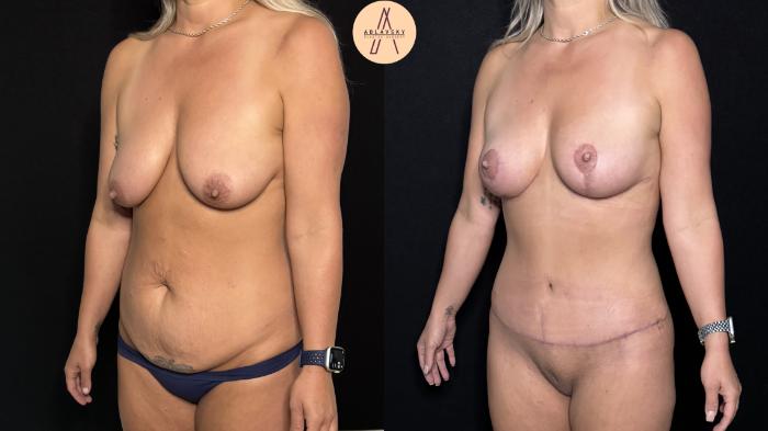 Before & After Mommy Makeover Case 413 Left Oblique View in San Antonio, Texas