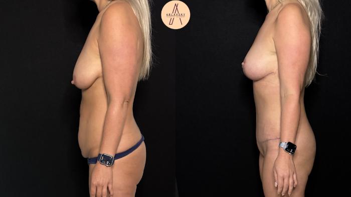 Before & After Mommy Makeover Case 413 Left Side View in San Antonio, Texas