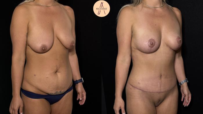 Before & After Mommy Makeover Case 413 Right Oblique View in San Antonio, Texas