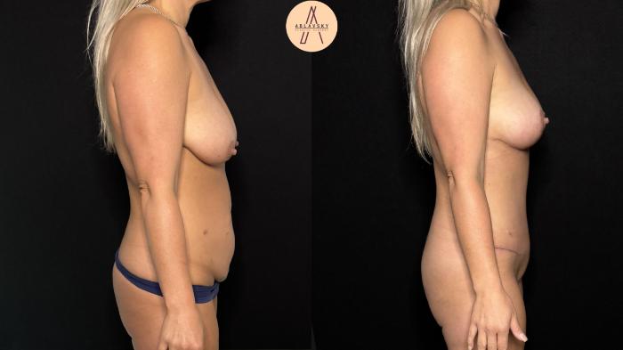 Before & After Mommy Makeover Case 413 Right Side View in San Antonio, Texas