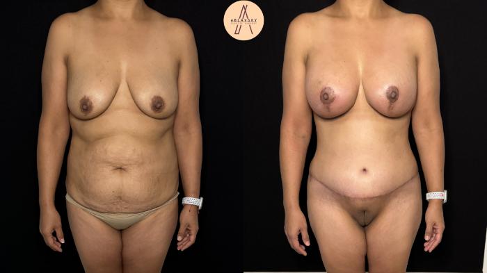 Before & After Mommy Makeover Case 418 Front View in San Antonio, Texas