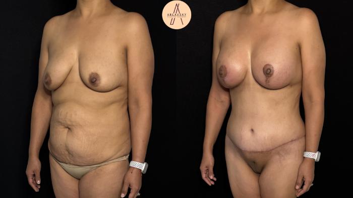 Before & After Mommy Makeover Case 418 Left Oblique View in San Antonio, Texas