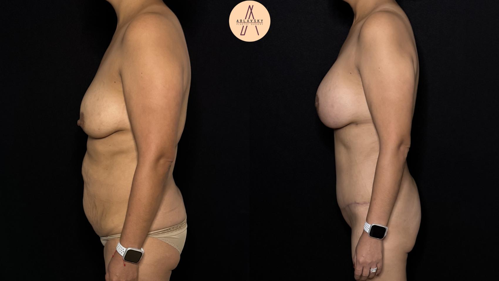 Before & After Liposuction Case 418 Left Side View in San Antonio, Texas