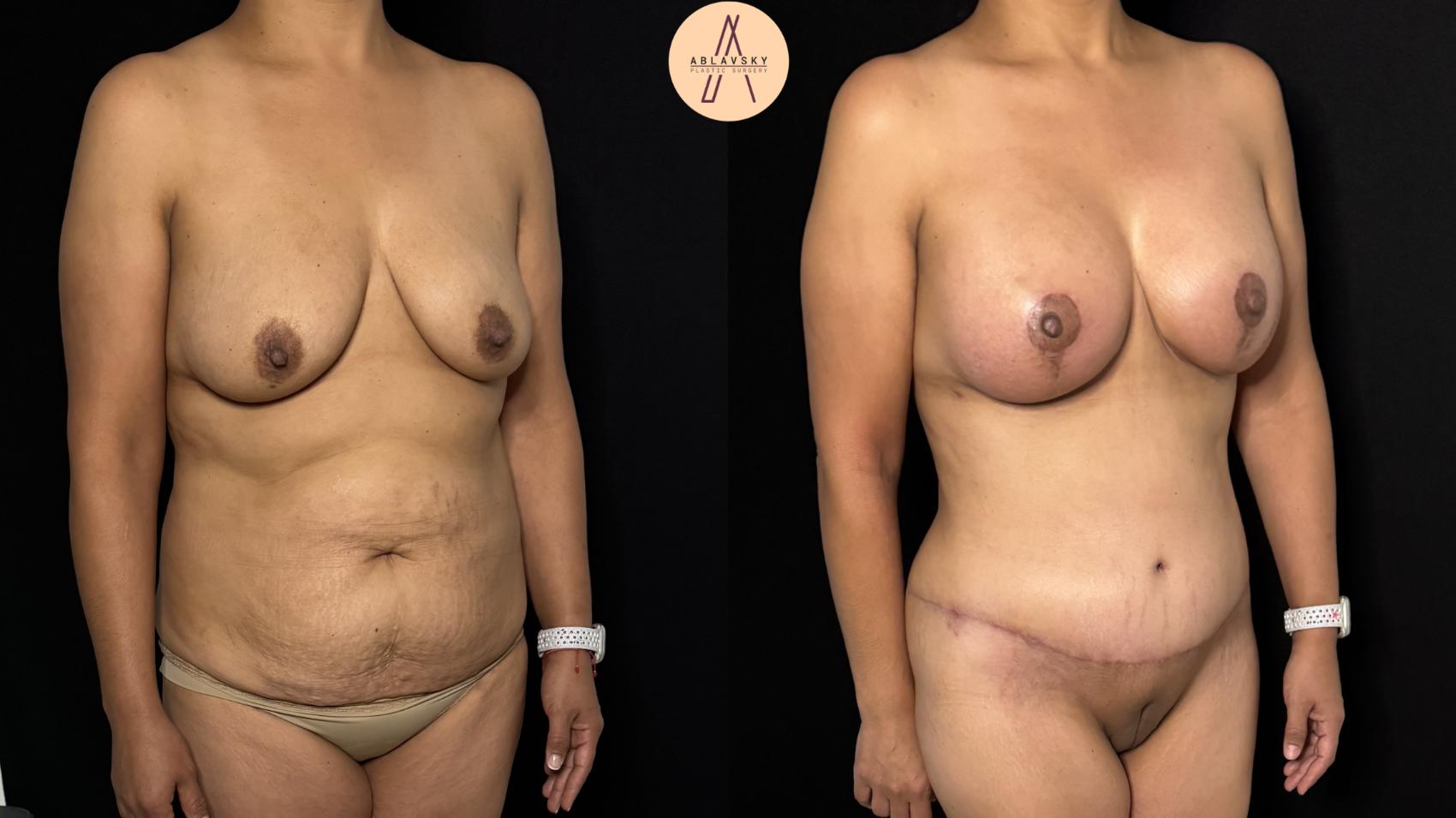 Before & After Mommy Makeover Case 418 Right Oblique View in San Antonio, Texas