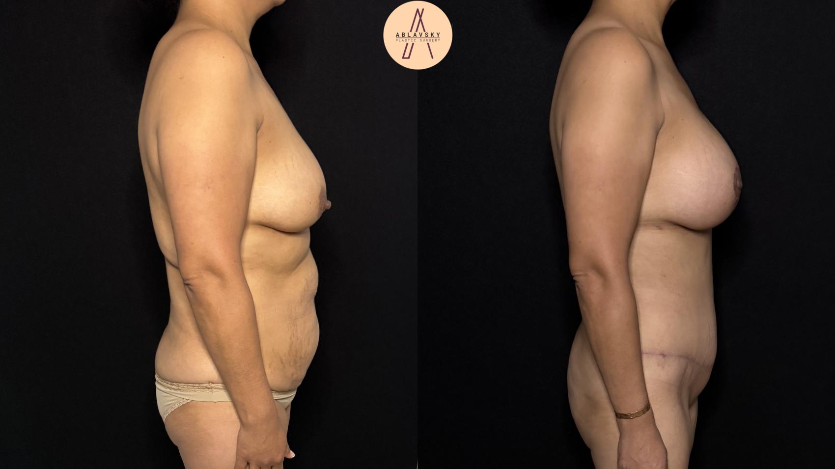 Before & After Liposuction Case 418 Right Side View in San Antonio, Texas
