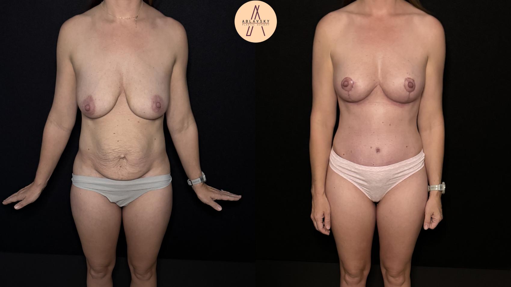 Before & After Mommy Makeover Case 472 Front View in San Antonio, Texas