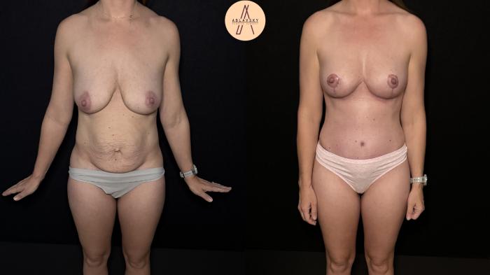 Before & After Mommy Makeover Case 472 Front View in San Antonio, Texas