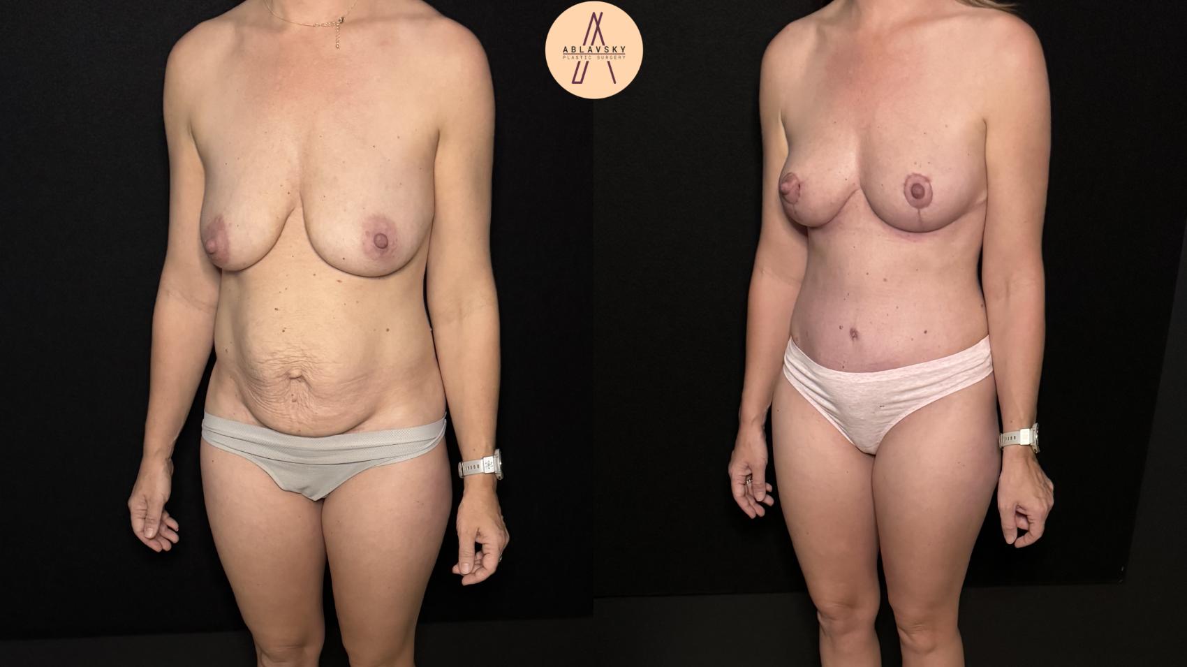 Before & After Mommy Makeover Case 472 Left Oblique View in San Antonio, Texas