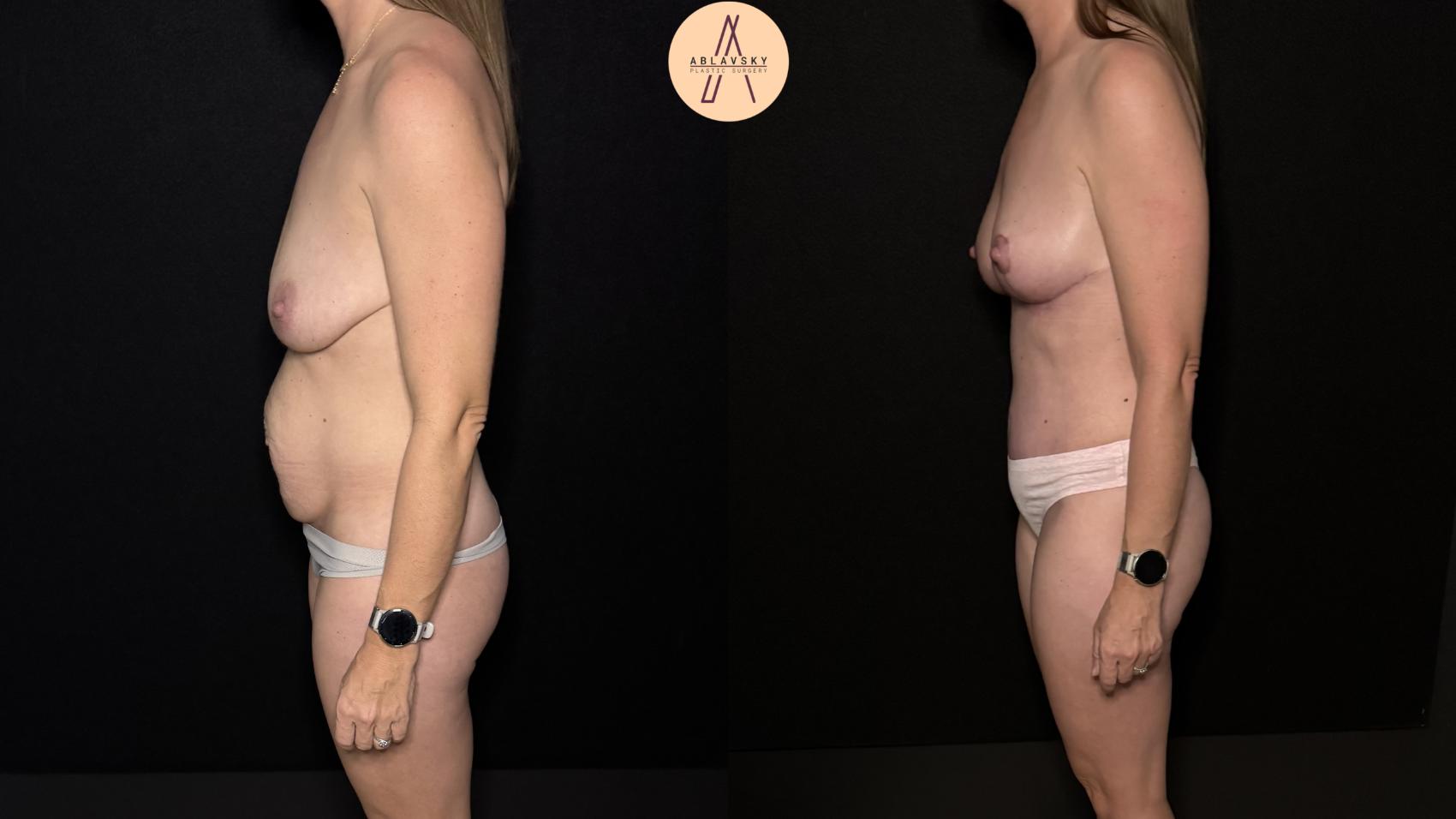 Before & After Mommy Makeover Case 472 Left Side View in San Antonio, Texas