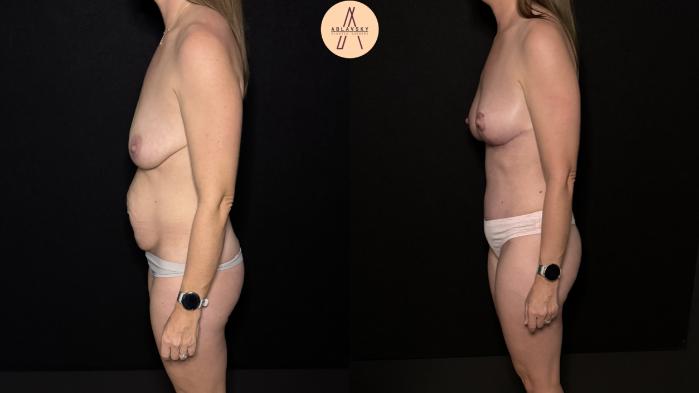 Before & After Mommy Makeover Case 472 Left Side View in San Antonio, Texas