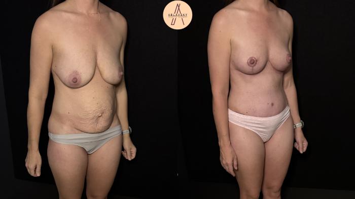 Before & After Mommy Makeover Case 472 Right Oblique View in San Antonio, Texas