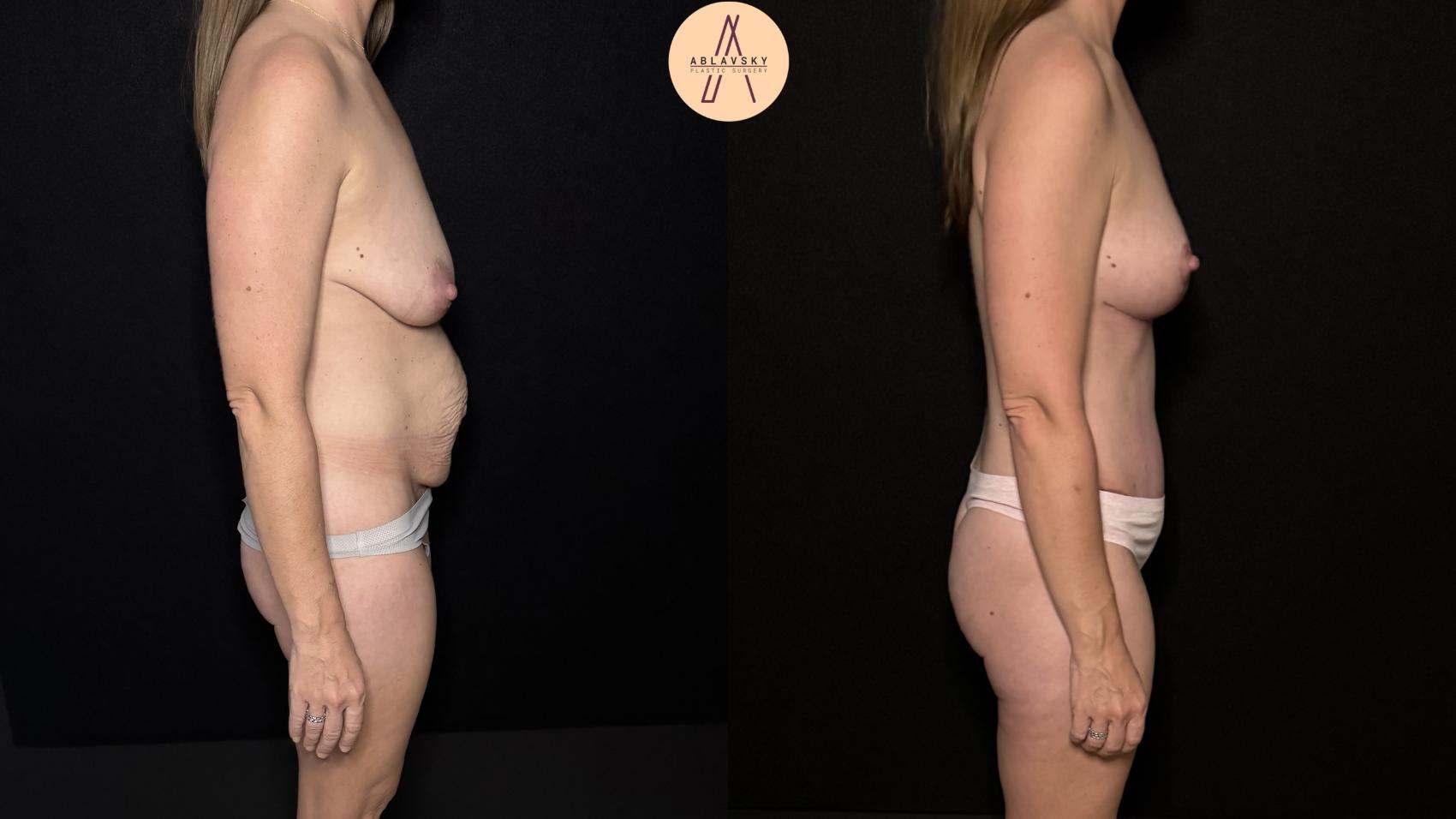 Before & After Mommy Makeover Case 472 Right Side View in San Antonio, Texas