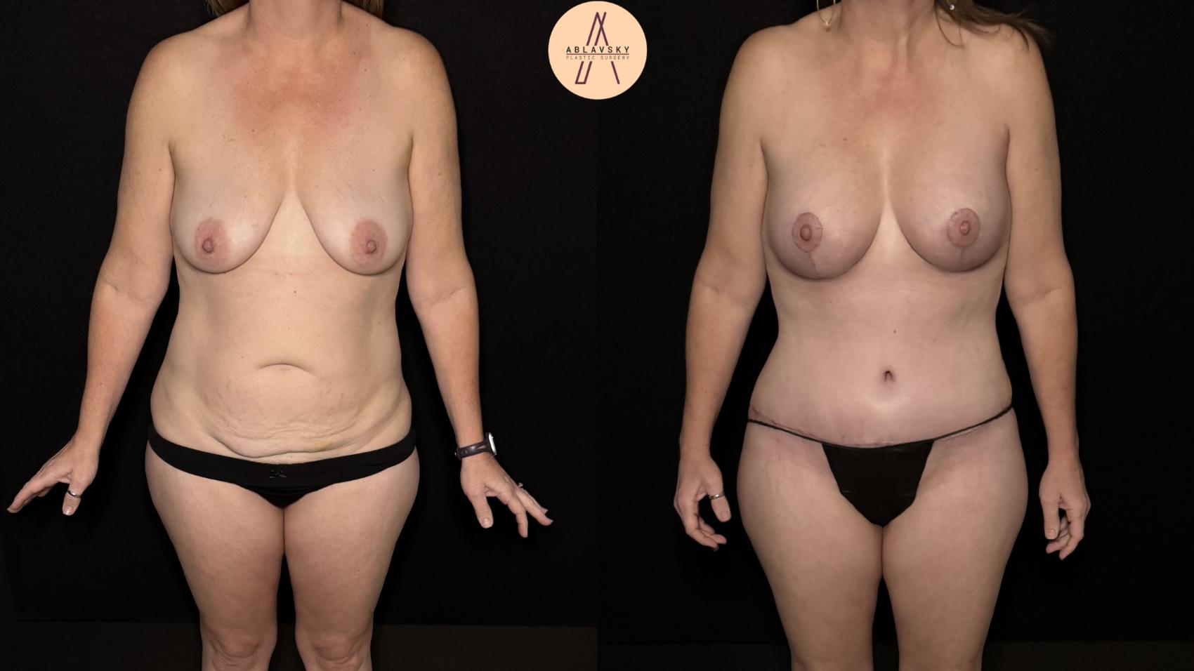 Before & After Mommy Makeover Case 494 Front View in San Antonio, Texas