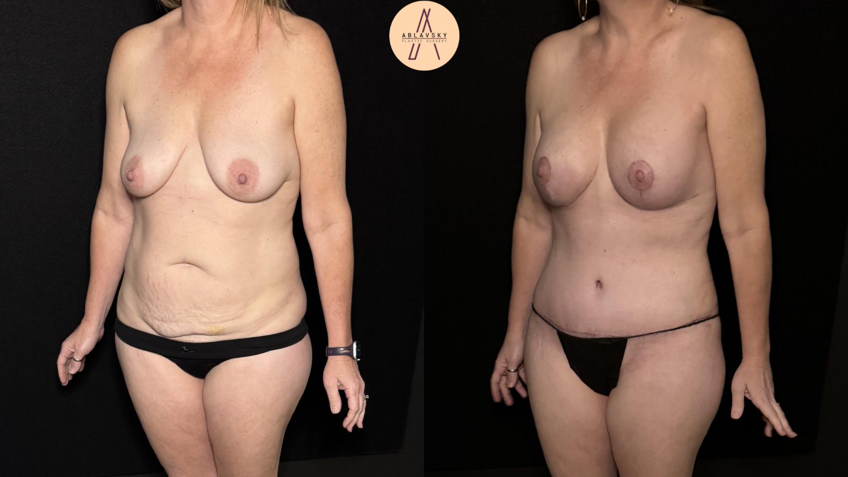 Before & After Mommy Makeover Case 494 Left Oblique View in San Antonio, Texas