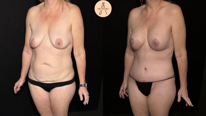 Before & After Mommy Makeover Case 494 Left Oblique View in San Antonio, Texas