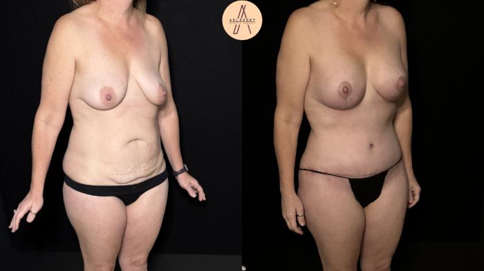 Before & After Mommy Makeover Case 494 Right Oblique View in San Antonio, Texas