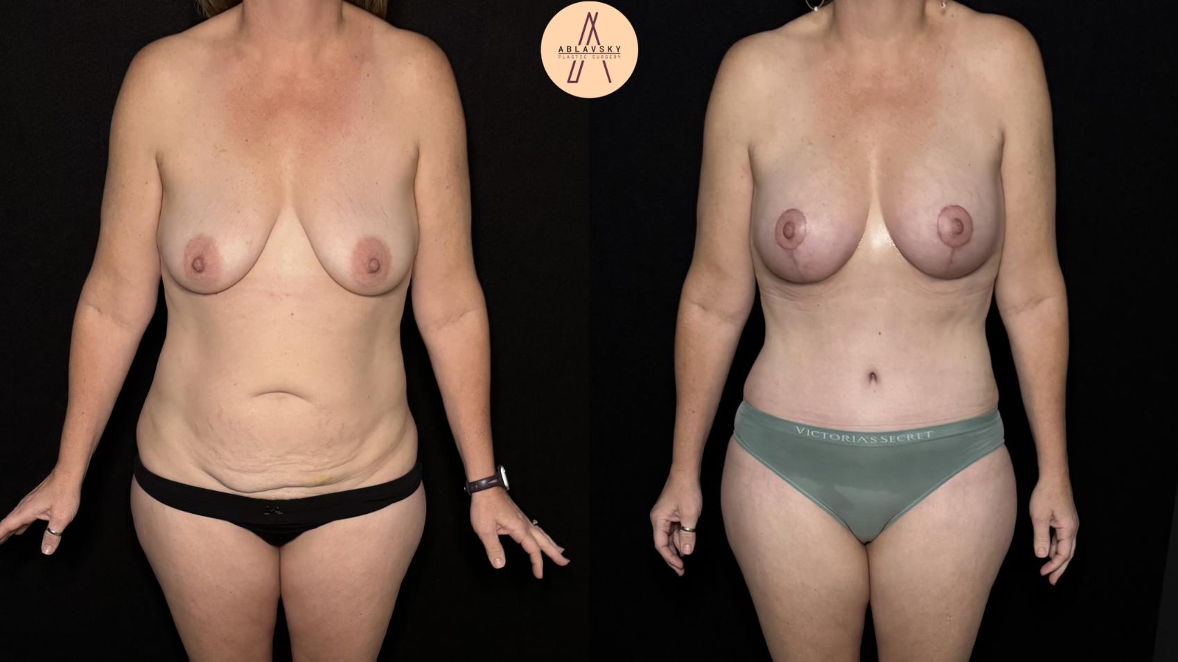 Before & After Mommy Makeover Case 501 Front View in San Antonio, Texas