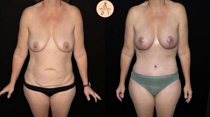 Before & After Mommy Makeover Case 501 Front View in San Antonio, Texas
