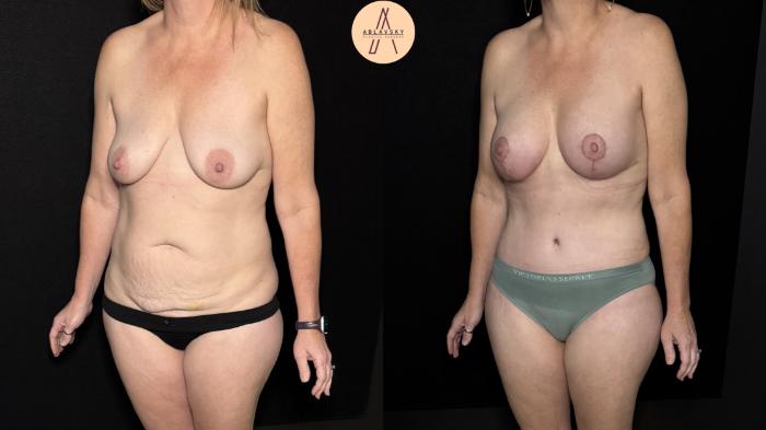Before & After Mommy Makeover Case 501 Left Oblique View in San Antonio, Texas