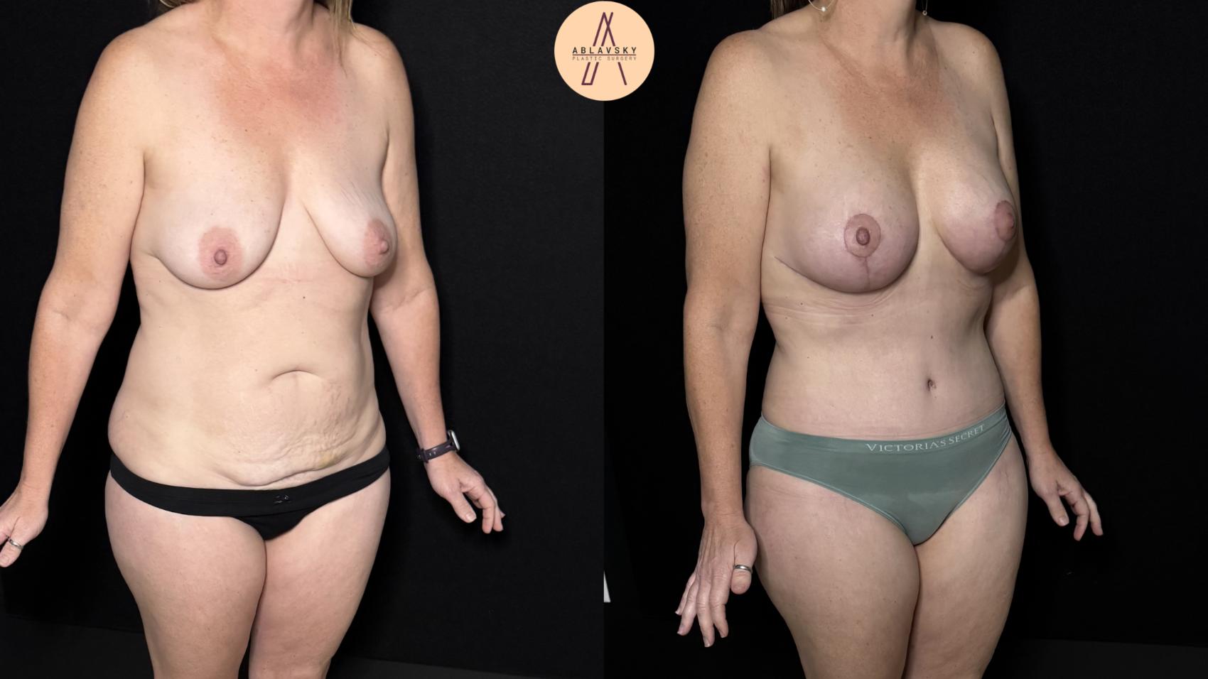 Before & After Mommy Makeover Case 501 Right Oblique View in San Antonio, Texas