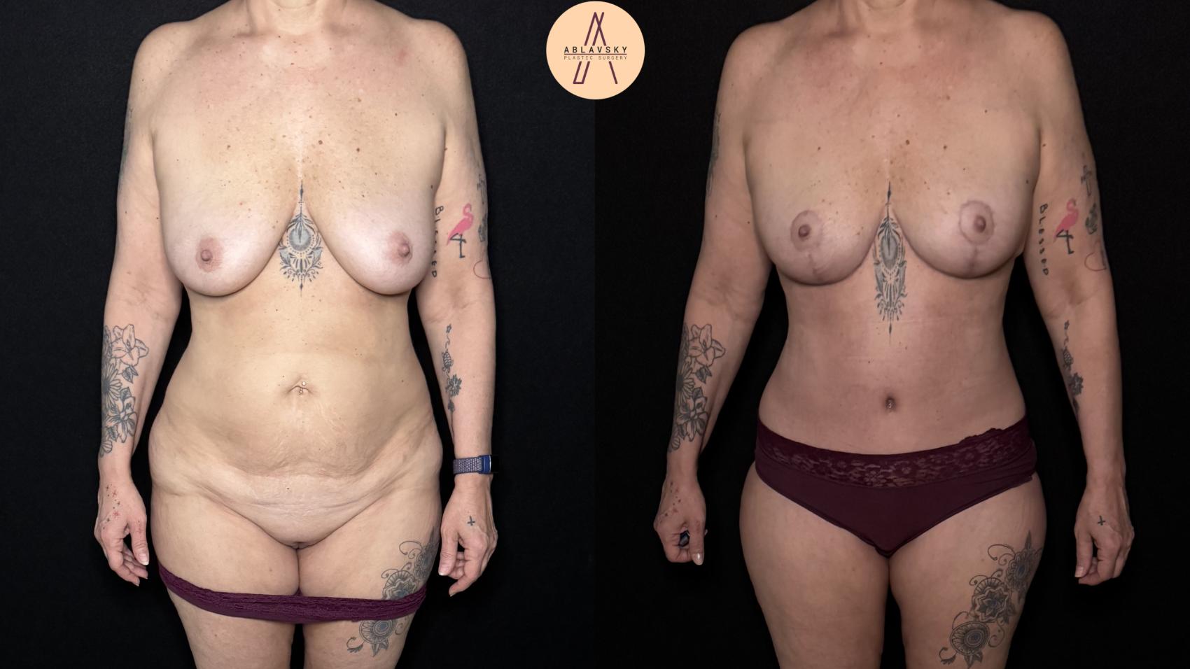 Before & After Mommy Makeover Case 512 Front View in San Antonio, Texas