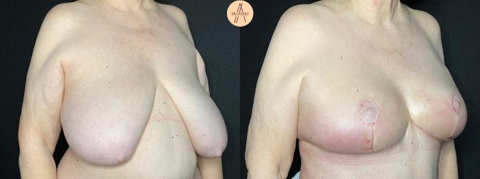 Before & After Mommy Makeover Case 65 Right Oblique View in San Antonio, Texas