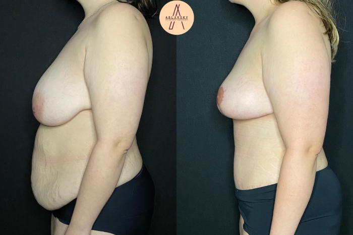 Before & After Tummy Tuck Case 84 Left Side View in San Antonio, Texas