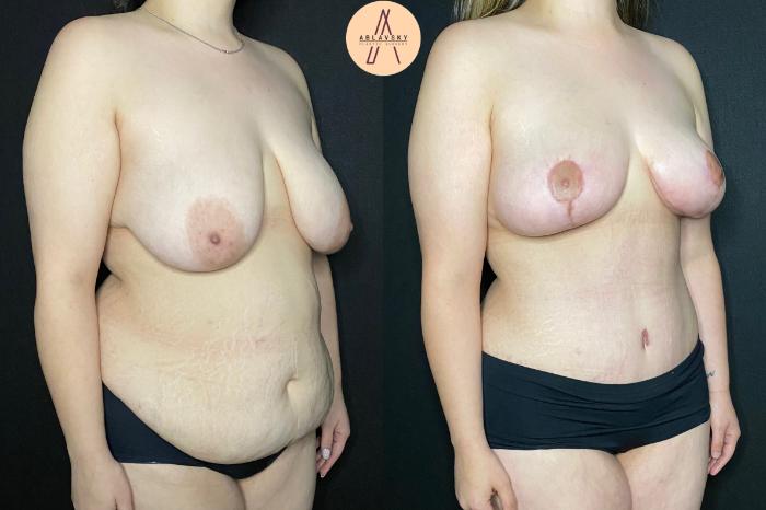 Before & After Mommy Makeover Case 84 Right Oblique View in San Antonio, Texas