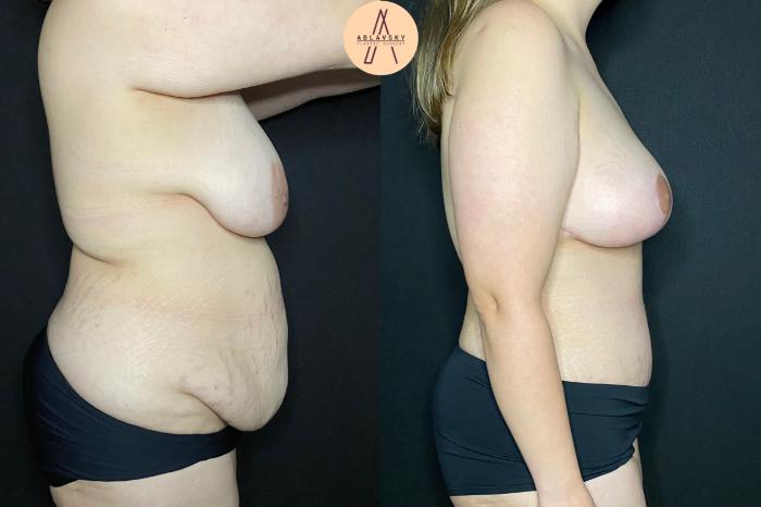 Before & After Liposuction Case 84 Right Side View in San Antonio, Texas
