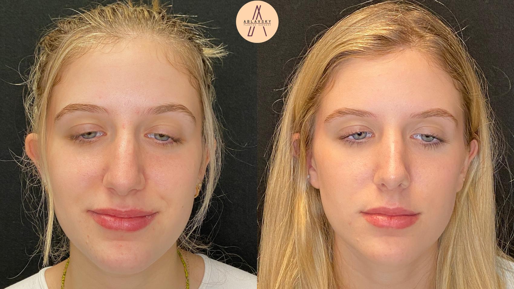 Before & After Rhinoplasty Case 48 Front View in San Antonio, Texas