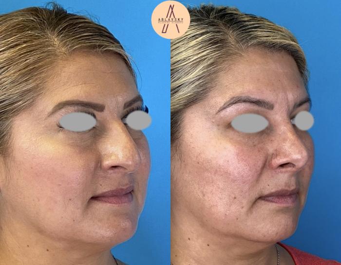 Before & After Rhinoplasty Case 8 Right Oblique View in San Antonio, Texas