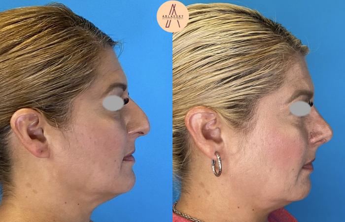 Before & After Rhinoplasty Case 8 Right Side View in San Antonio, Texas