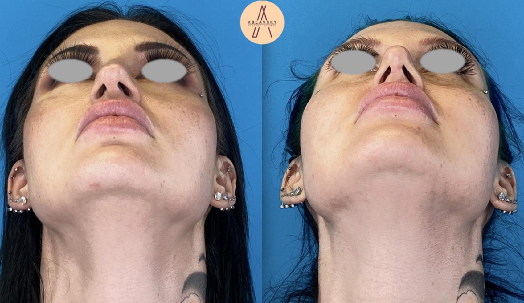 Before & After Rhinoplasty Case 9 Caudal-cephalic View in San Antonio, Texas
