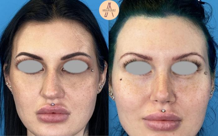 Before & After Rhinoplasty Case 9 Front View in San Antonio, Texas