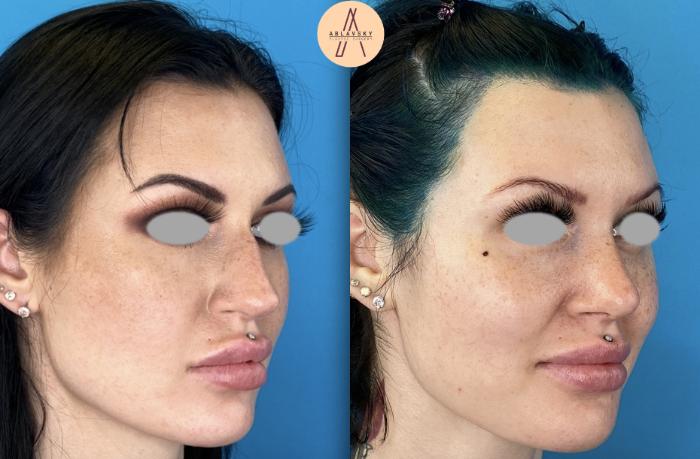 Before & After Rhinoplasty Case 9 Right Oblique View in San Antonio, Texas
