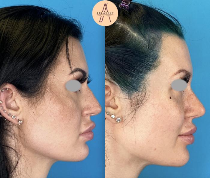 Before & After Rhinoplasty Case 9 Right Side View in San Antonio, Texas