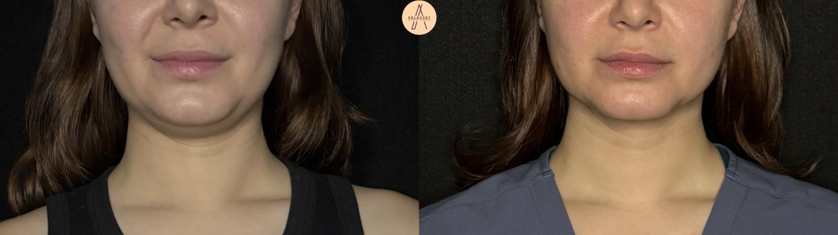 Before & After Submental Liposuction Case 382 Front View in San Antonio, Texas