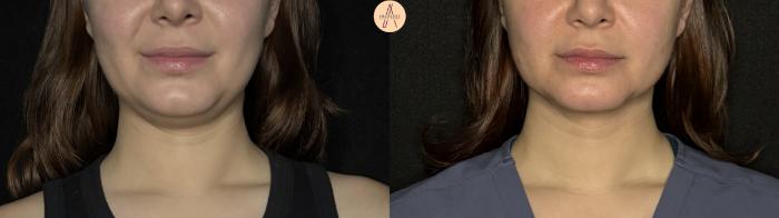 Before & After Submental Liposuction Case 382 Front View in San Antonio, Texas