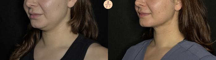 Before & After Submental Liposuction Case 382 Left Oblique View in San Antonio, Texas