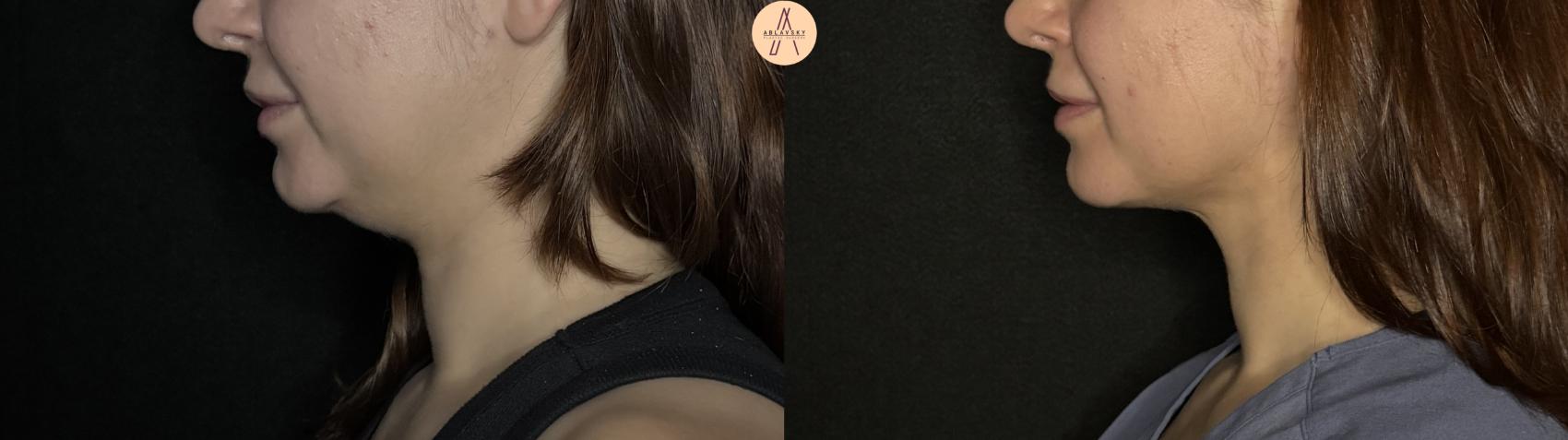 Before & After Submental Liposuction Case 382 Left Side View in San Antonio, Texas