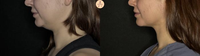 Before & After Submental Liposuction Case 382 Left Side View in San Antonio, Texas