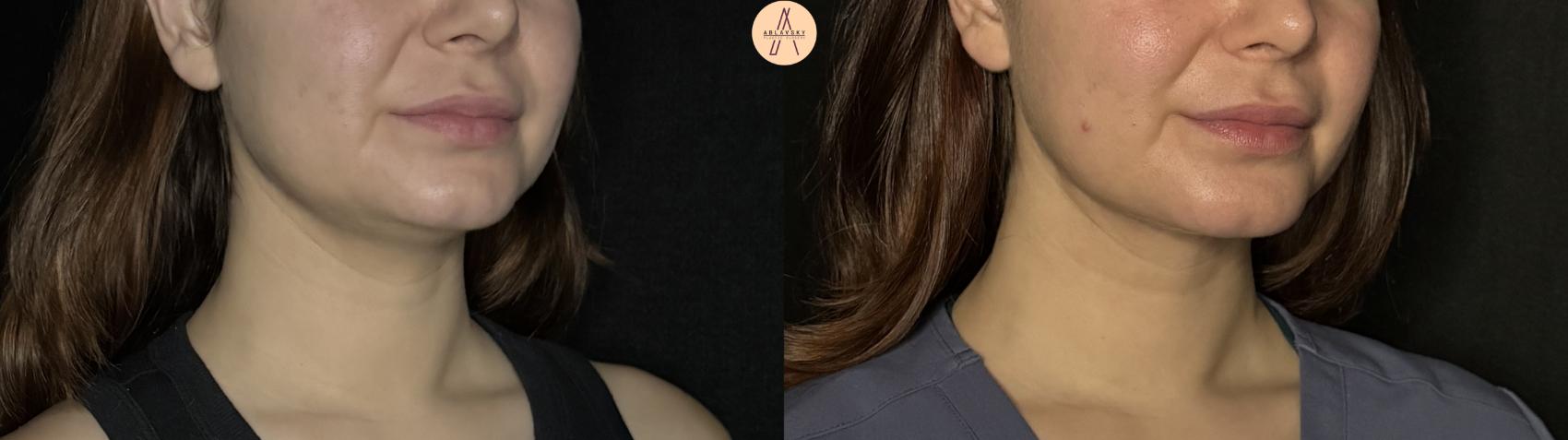 Before & After Submental Liposuction Case 382 Right Oblique View in San Antonio, Texas