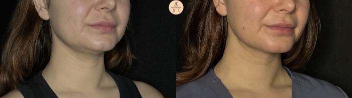 Before & After Submental Liposuction Case 382 Right Oblique View in San Antonio, Texas