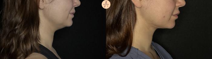 Before & After Submental Liposuction Case 382 Right Side View in San Antonio, Texas