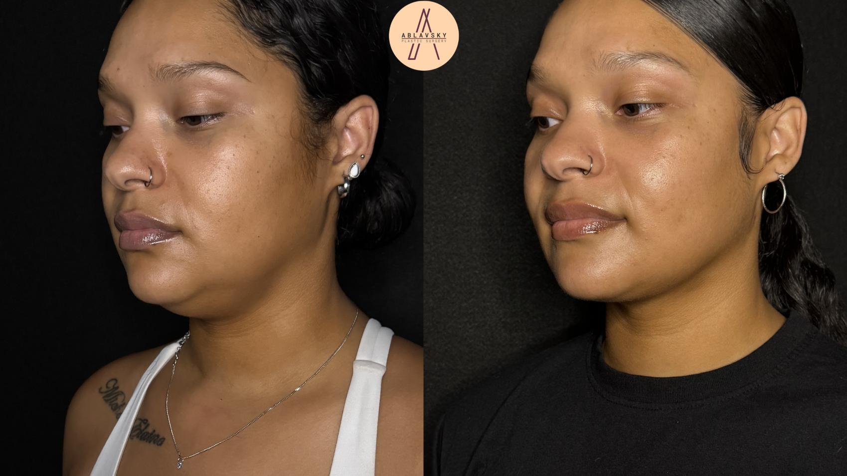 Before & After Submental Liposuction Case 385 Left Oblique View in San Antonio, Texas