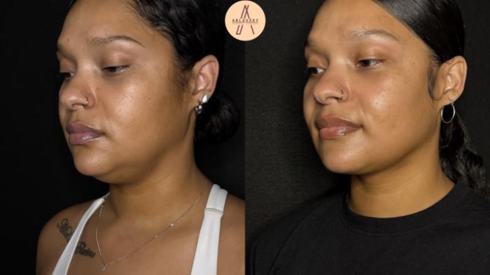 Before & After Submental Liposuction Case 385 Left Oblique View in San Antonio, Texas
