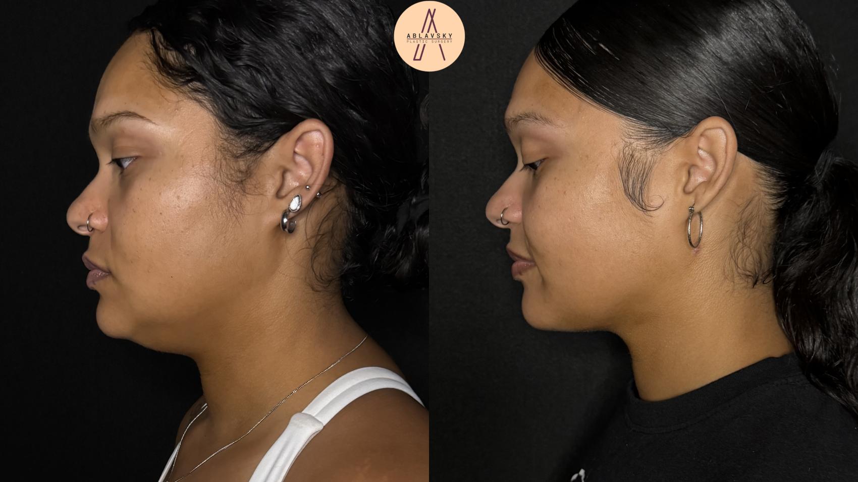 Before & After Submental Liposuction Case 385 Left Side View in San Antonio, Texas
