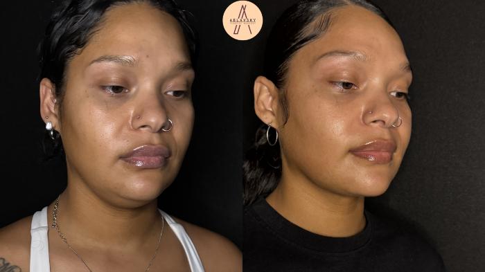 Before & After Submental Liposuction Case 385 Right Oblique View in San Antonio, Texas